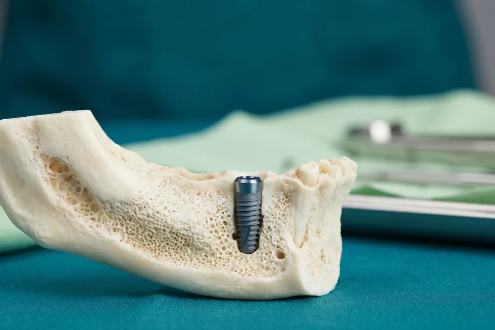 Implants dentaires