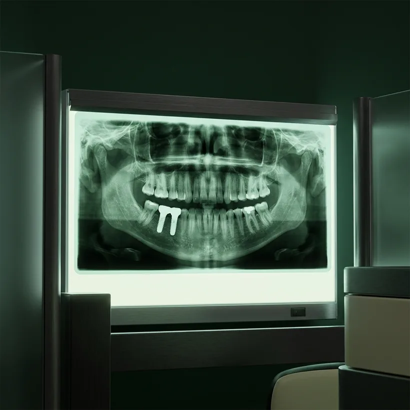 Radiographie panoramique d'une arcade réhabilitée sur implants